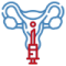 Hysteroscopic Fibroid Removal Procedure