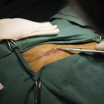 Laparoscopic Hernioplasty in Thane